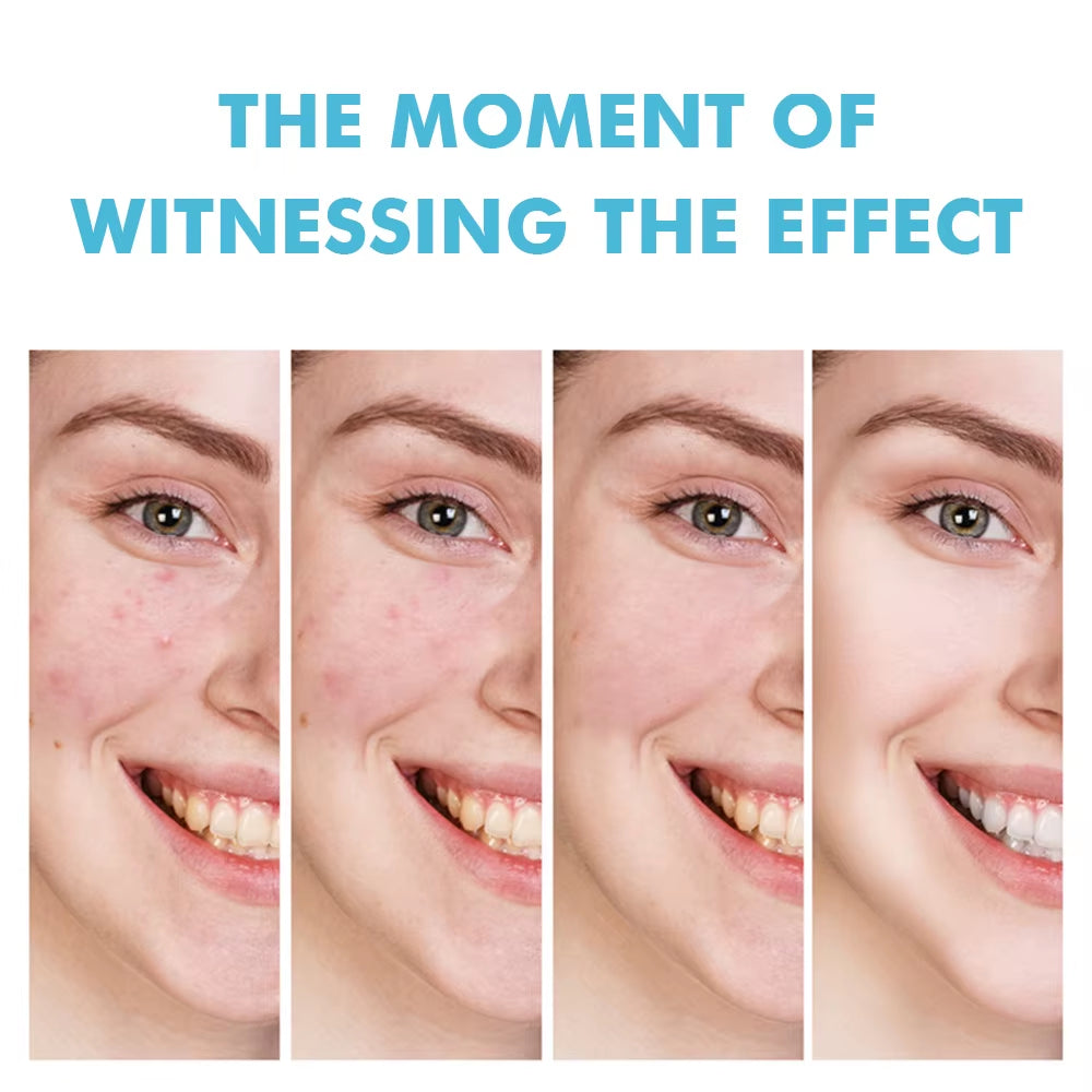Salicylic Acid Acne Cream Reduces Acne Marks, Removes Acne, Closes Mouth and Shrinks Pores, Plant Essence Acne Gel