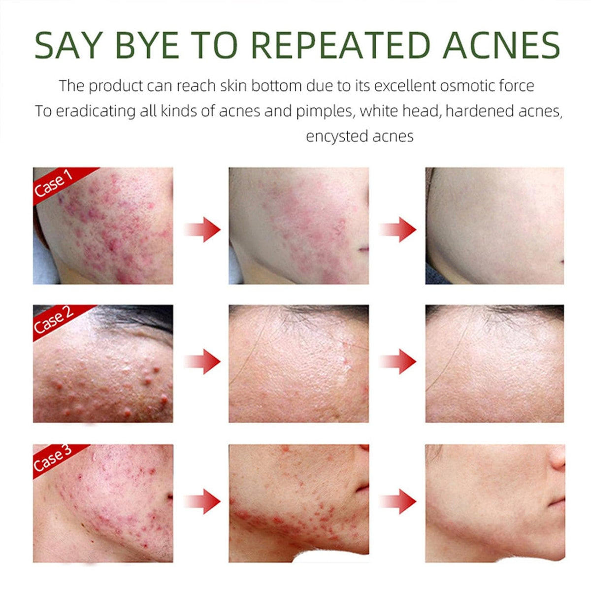 Acne Removing Face Cream,Natural Ingredients Professionally Remove Acne Marks,For Teens & Adults Anti-Acne Moisturizer Pimple Cream