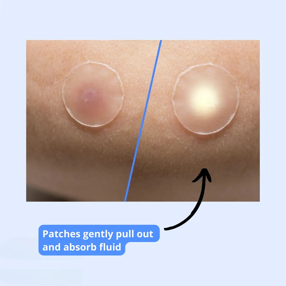 SMACNE Sticks and Acne Pimple Patches