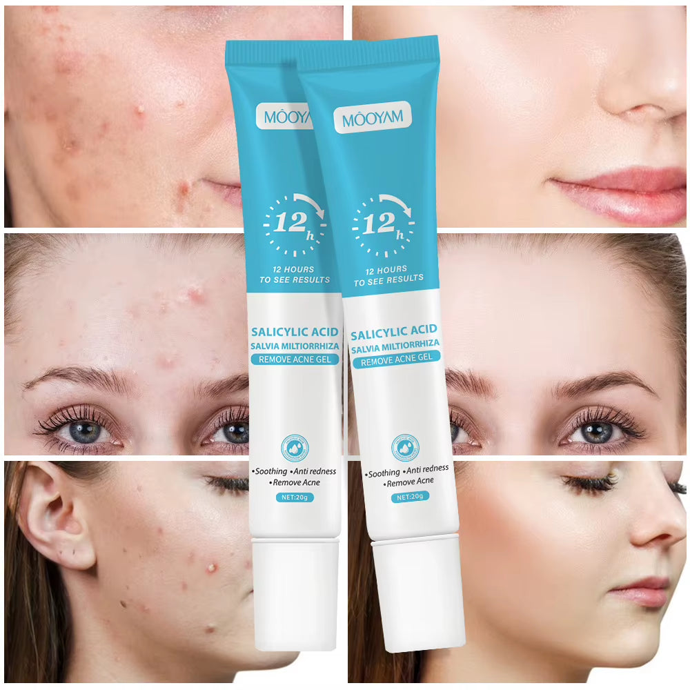 Salicylic Acid Acne Cream Reduces Acne Marks, Removes Acne, Closes Mouth and Shrinks Pores, Plant Essence Acne Gel
