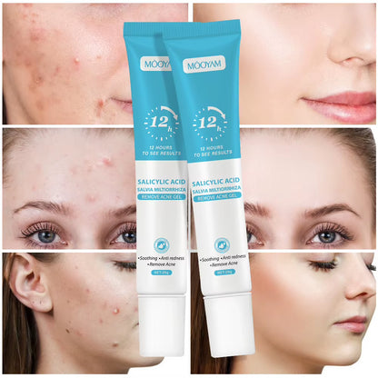 Salicylic Acid Acne Cream Reduces Acne Marks, Removes Acne, Closes Mouth and Shrinks Pores, Plant Essence Acne Gel