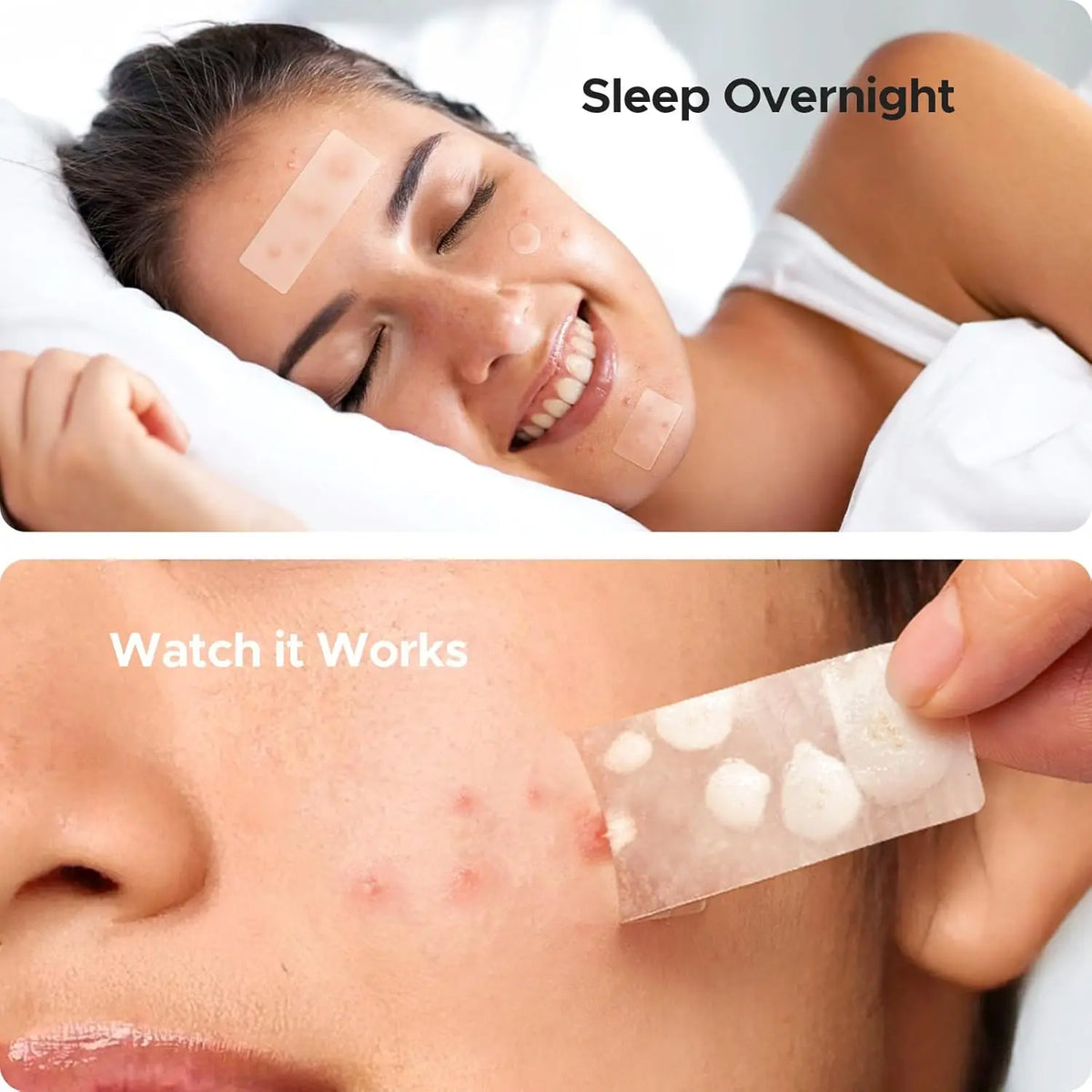 Large Pimple Patches for Face, 5Sizes XL Acne Patches, Big Hydrocolloid Bandages for Body, Chin, Forehead, Chest, Back Zit Breakouts, Hydrocolloid Patch (Strip, Square, Dot 443 Count)