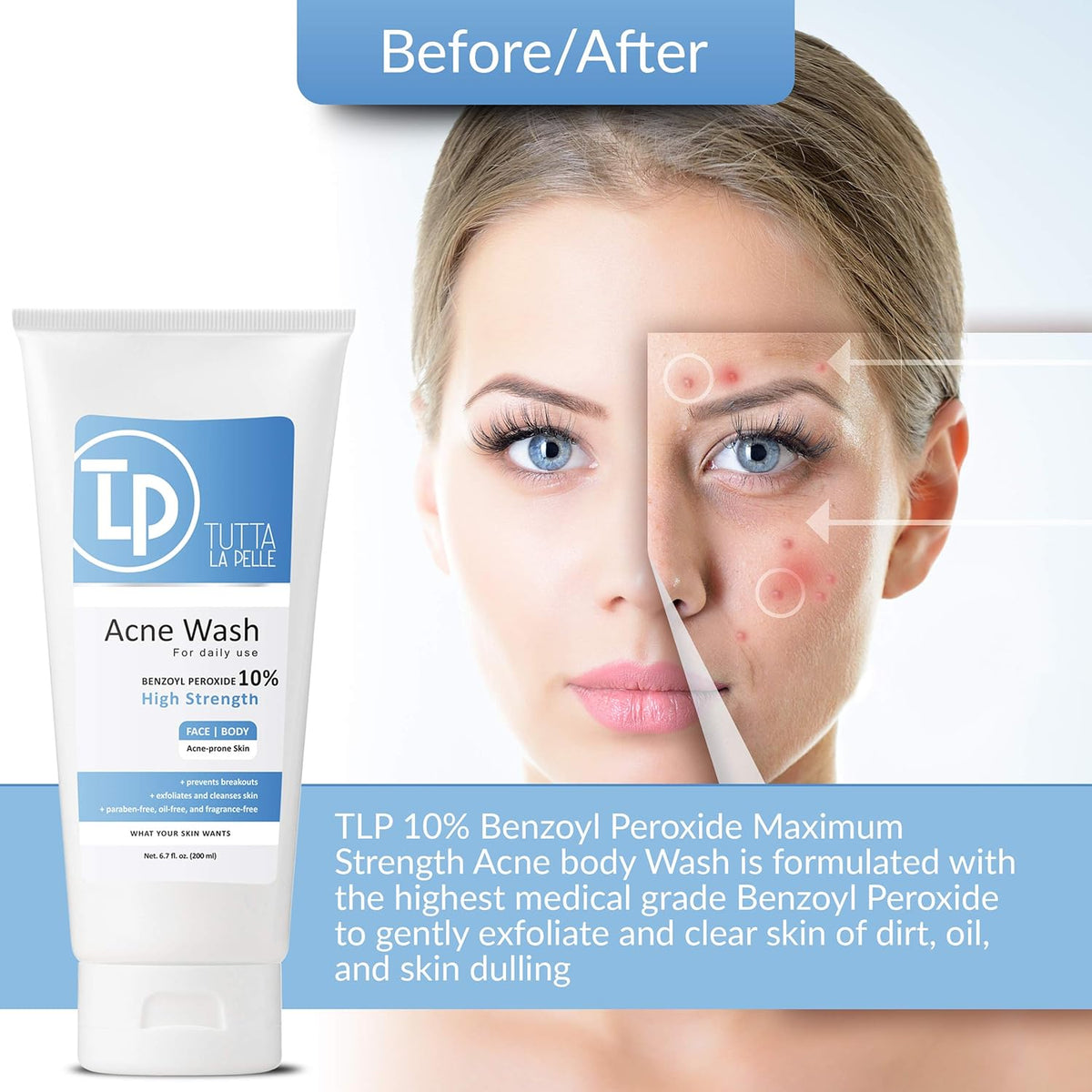 Benzoyl Peroxide Body Wash 10% - Acne Face Wash & Acne Body Wash - Butt Acne Treatment & Back Acne Treatment - Highest Grade Medical Facial Cleanser, Maximum Strength Acne Wash 6.7 Oz